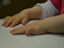 bei einem Kind ist der kleine Finger kontrakt