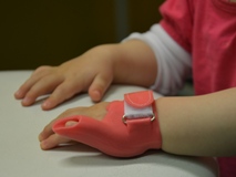 Silikonorthese kleiner Finger ein kontrakter Finger wird mit einer Silikonorthese grade gehalten