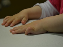 Kontrakter Finger bei einem Kind ist der kleine Finger kontrakt
